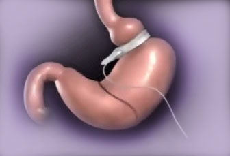 lap-band-surgery