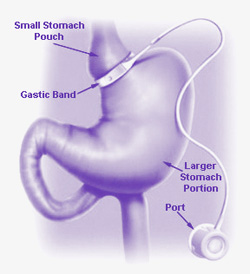lap-band-surgery-encino