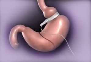 lap-band-surgery-huntington-beach