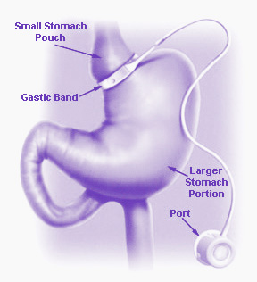 lap-band-surgery-thousand-oaks