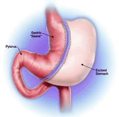 sleeve-gastrectomy-long-beach