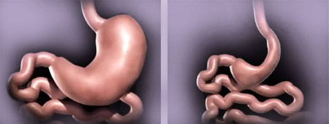 sleeve-gastrectomy-oxnard