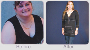 Sleeve Surgery